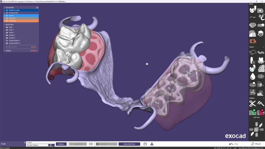 exocad announced the release of PartialCAD 3.1 Rijeka, with new and improved usability features for the design of high-quality removable partial denture frameworks. (Source: exocad)